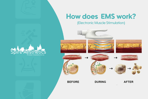 EMS treatment for post pregnancy weight loss treatment Bridgwater