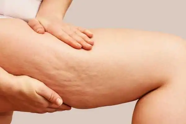 Image of woman showing leg with cellulite Bridgwater