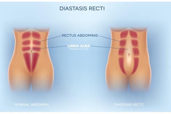What Non-Surgical Options Are Available for Diastasis Recti Bridgwater?