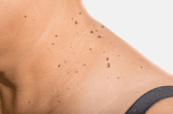Are you looking for easy skin tag removal Bridgwater - then contact Spire today!