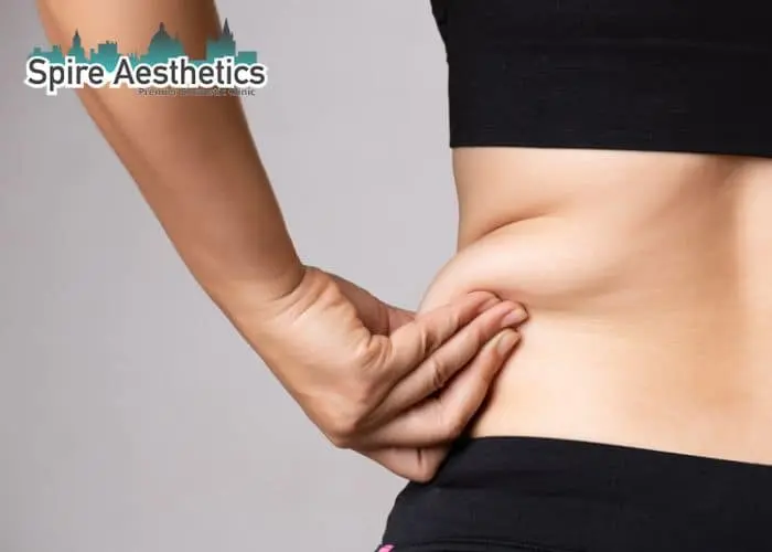 Image of woman pinching fat on their hips Bridgwater. Fat Freezing treatment 
