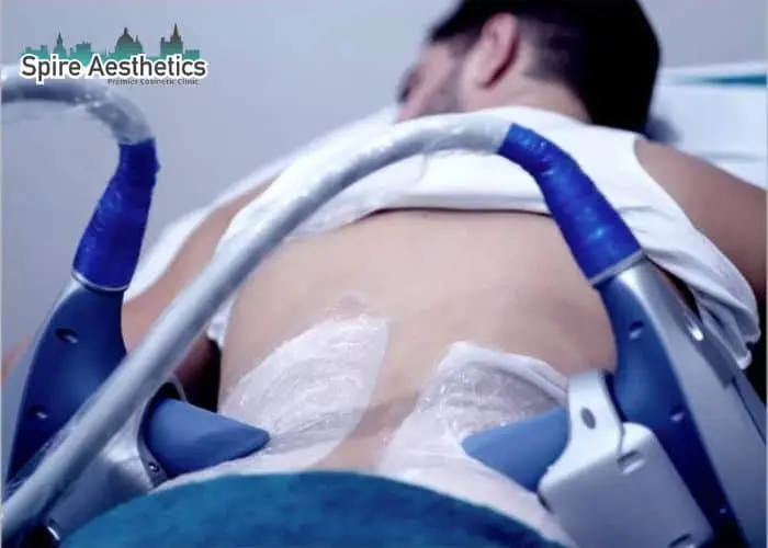 Man having fat freezing treatment done on love handles before a competitions Bridgwater to create a sculpted look.