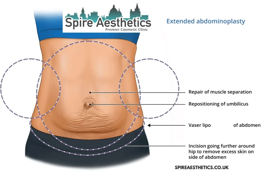 Understanding Loose Skin After Gastric Band Bridgwater Surgery and HIFU Treatment