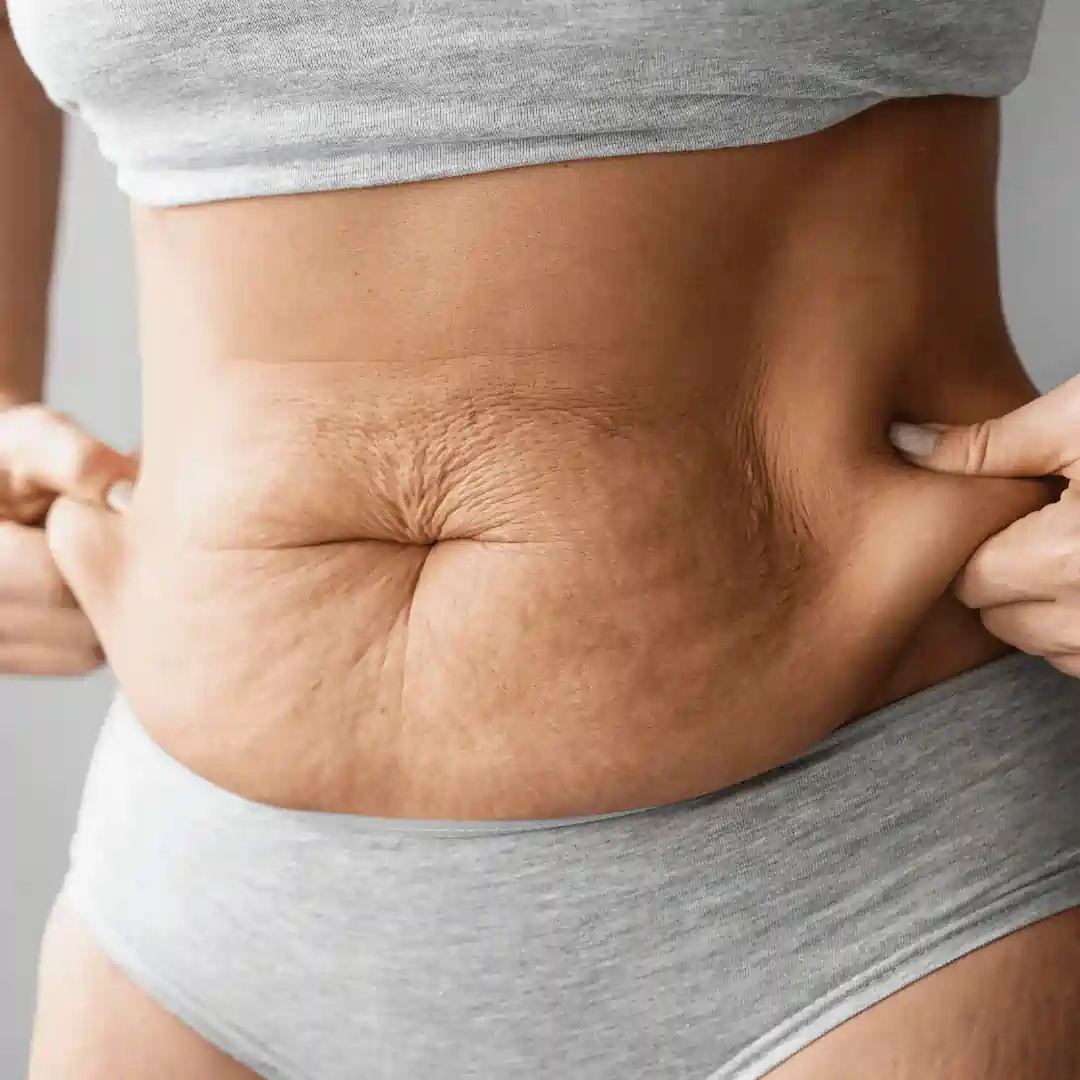 Is It Normal to Have Loose Skin After Pregnancy Bridgwater?