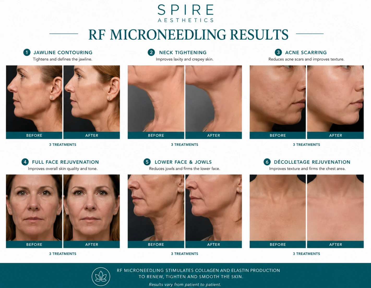 RF Microneedling Skin tightening Bridgwater results