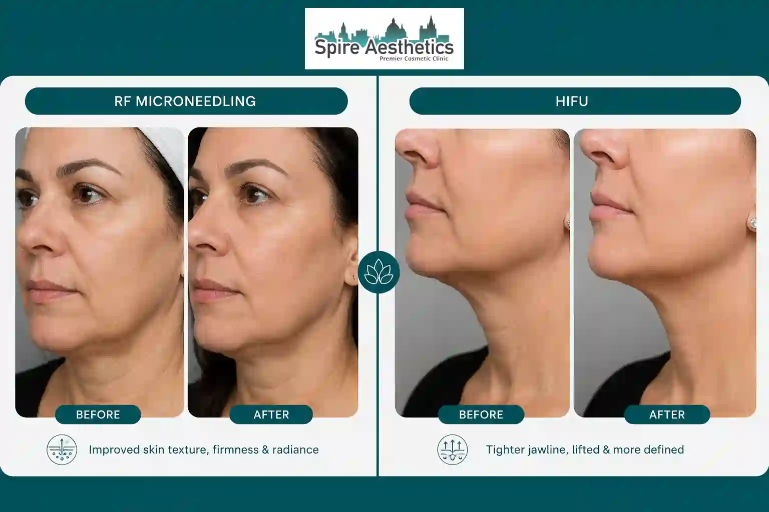 Can RF Microneedling and HIFU Be Combined Bridgwater?