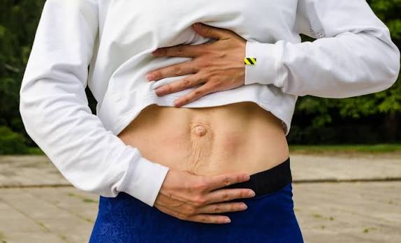 When Could Diastasis Recti Be the Missing Piece of the Puzzle Bridgwater?