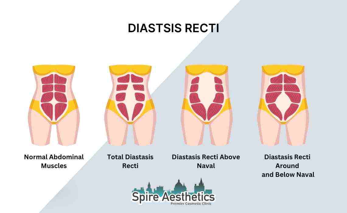 Is Non-Surgical Diastasis Recti Treatment Right for You? Common Concerns Answered Bridgwater
